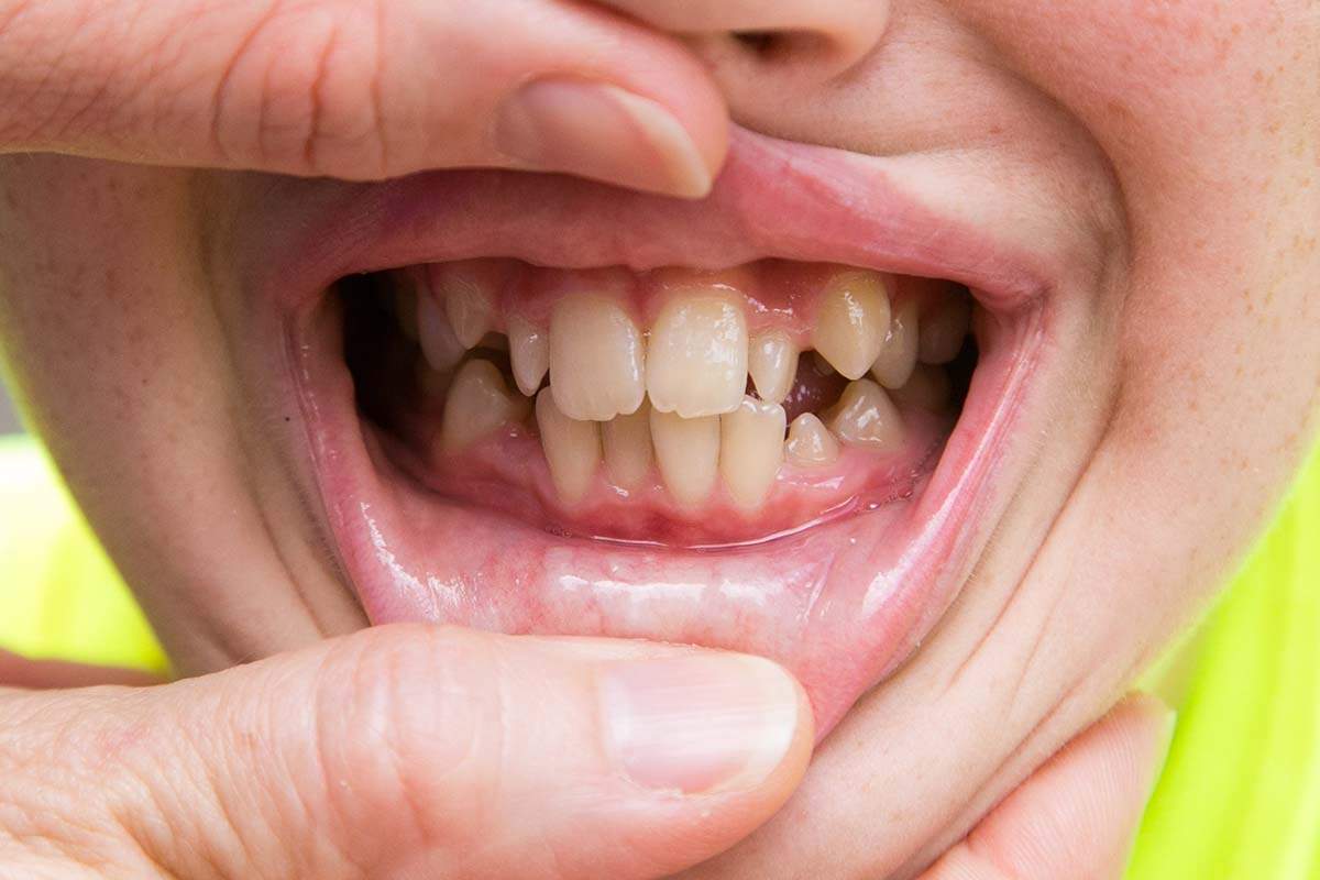 Child with crowded or crooked teeth needing orthodontic treatment