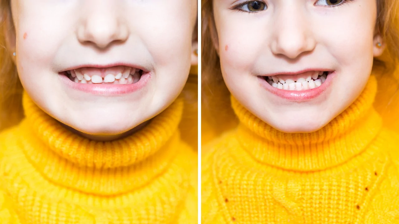 Child showing signs of overbite and underbite before and after orthodontic evaluation